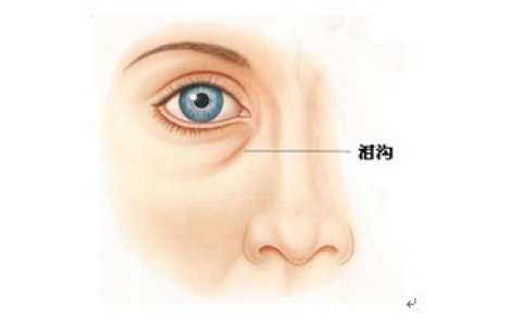 我来分享泪沟怎么去除。